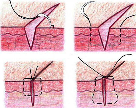 саморассасывающиеся швы заживают