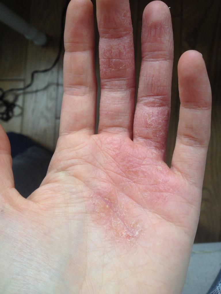 лечение кожи рук