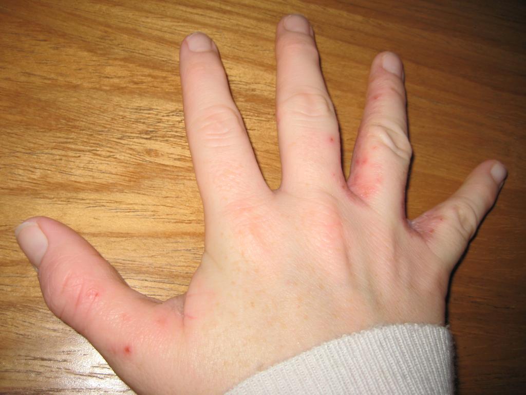 3103055 - Сухость кожи между пальцами рук
