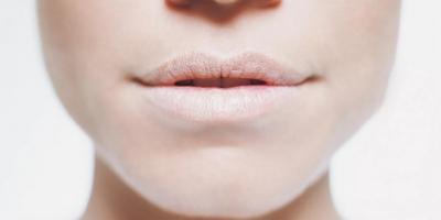 3103604 - Почему губы покрываются сухой коркой