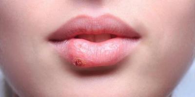 3103610 - Почему губы покрываются сухой коркой