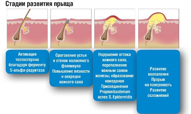 Стадии развития прыща