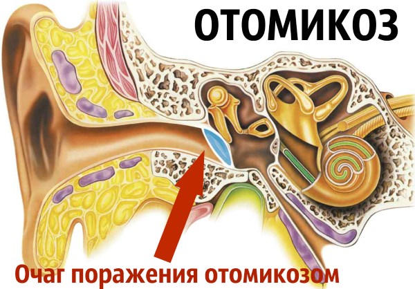 Шелушение и образование корочек в ушах. Причины и лечение перхоти и сухой кожи в ушах