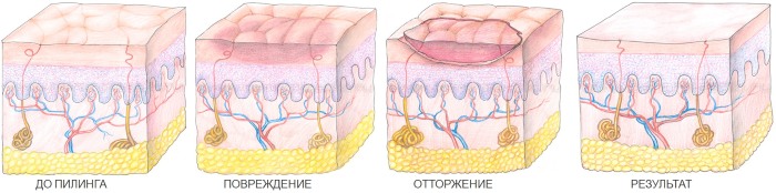 Лечение акне и постакне на лице: аппаратная косметология, препараты, лазером, жидким азотом, холодной плазмой, плазмолифтингом, кремами, гомеопатией, пиявками