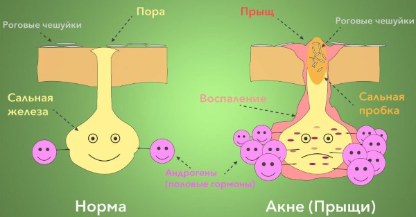 Акне - что это такое, как избавиться от прыщей на лице. Препараты, диета лазерное лечение, мезотерапия