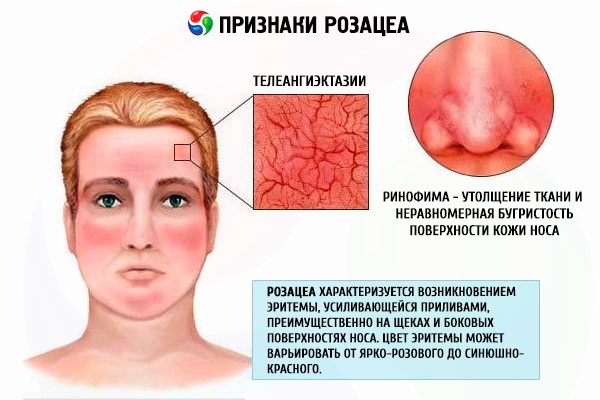 Акне - что это такое, как избавиться от прыщей на лице. Препараты, диета лазерное лечение, мезотерапия