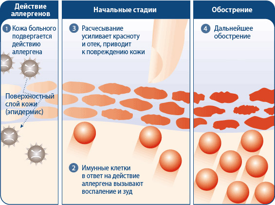 Дерматит на лице. Фото, симптомы, причины, лечение: мази, кремы, народные средства