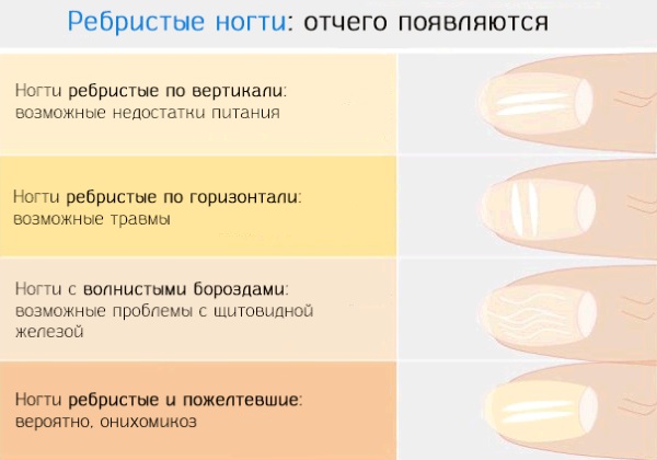 Ребристые ногти на руках у женщин. Причины и лечение, питание, уход