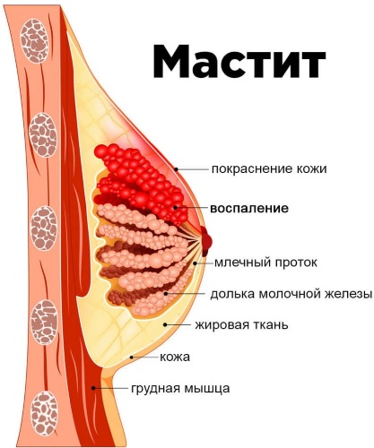 Болит грудь в середине цикла, второй половине, весь цикл. Почему набухла, что делать