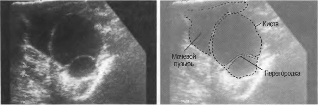 Киста у женщин узи. Цистоцеле мочевого пузыря на УЗИ. Киста в мочевом пузыре у женщин на УЗИ. Киста стенки мочевого пузыря. Киста мочевого пузыря на УЗИ.