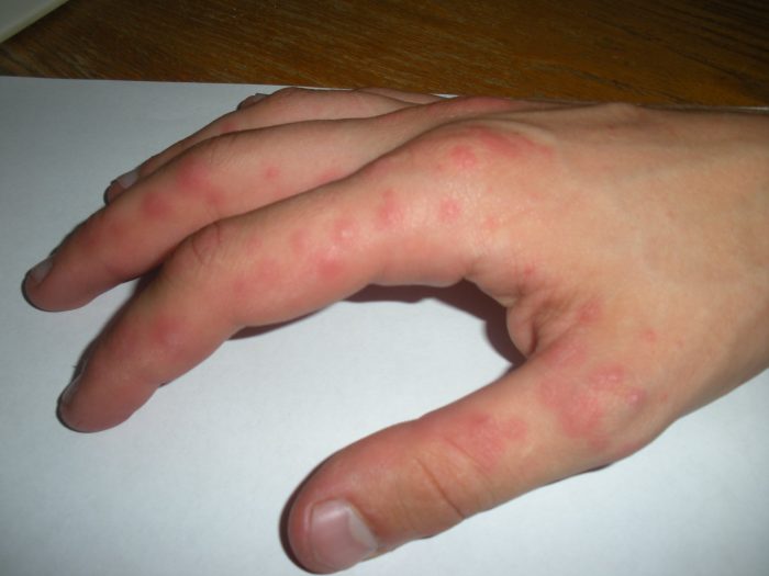 раздражение кожи между пальцами рук