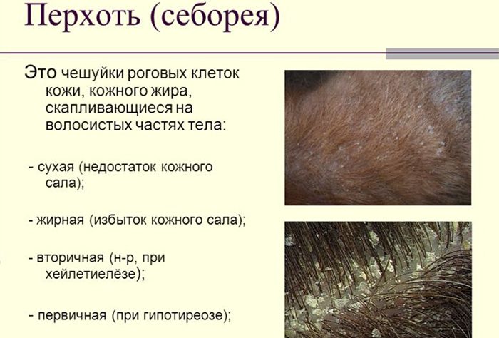 классификация себореи кожи головы