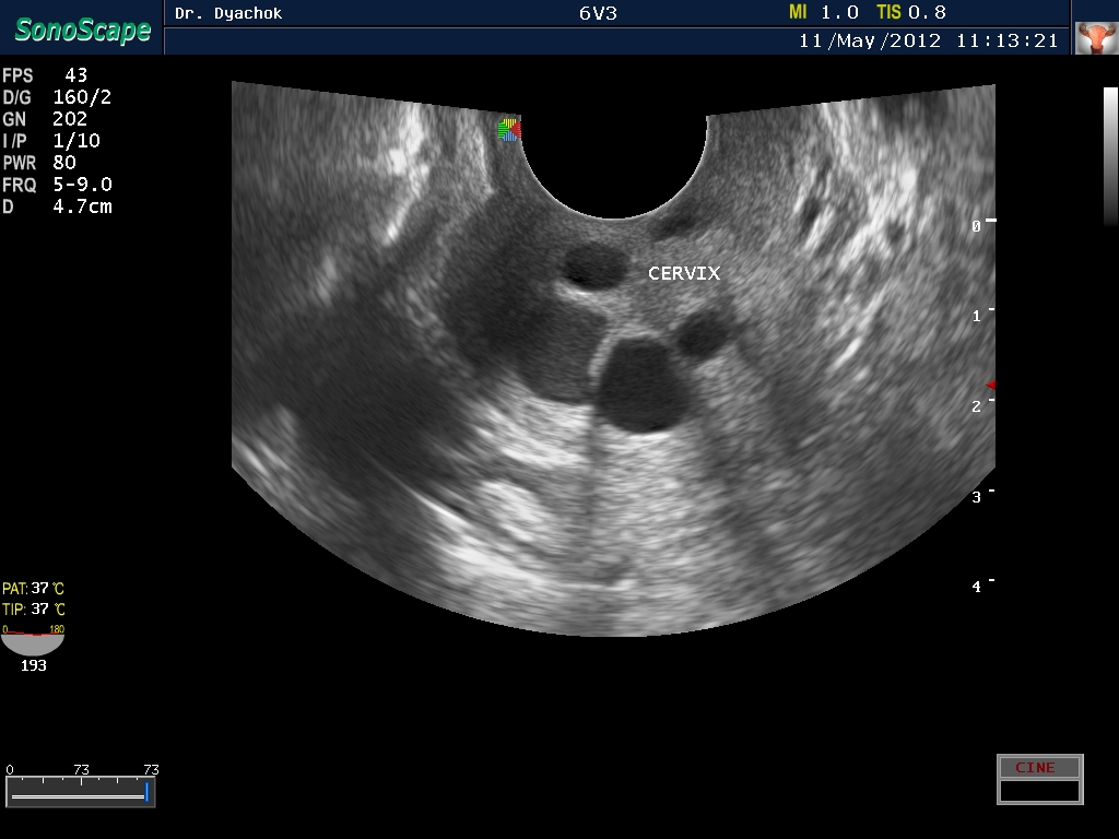Киста шейки матки на узи что это и как лечить фото