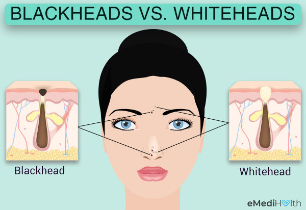 blackhead whitehead difference