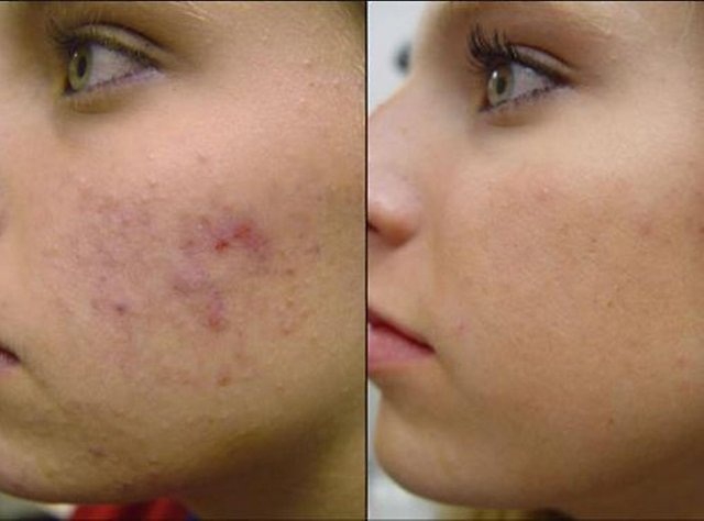 Подростковое акне: фото до и после лечения