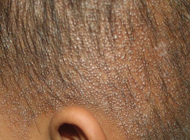 Гиперкератоз кожи головы