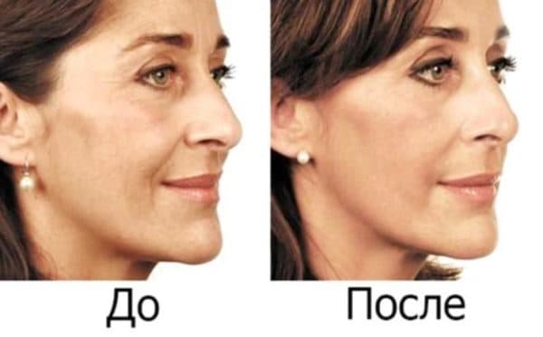 До и после применения маски для лица с димексидом