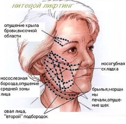 Рекомендуемые зоны для проведения нитевого лифтинга