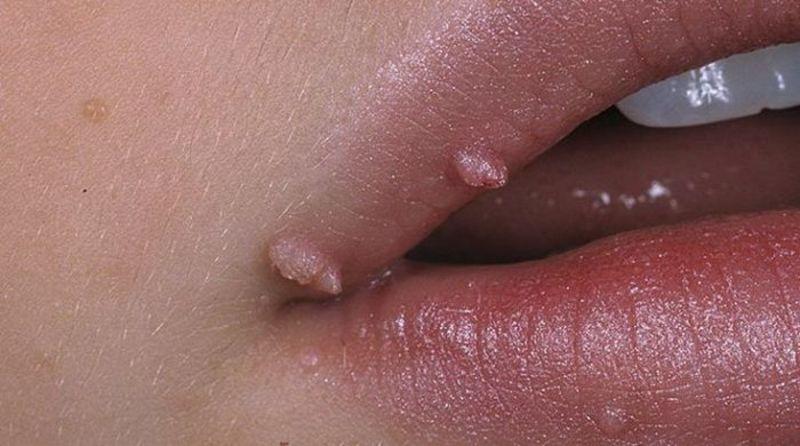 шишки на губах при ВПЧ
