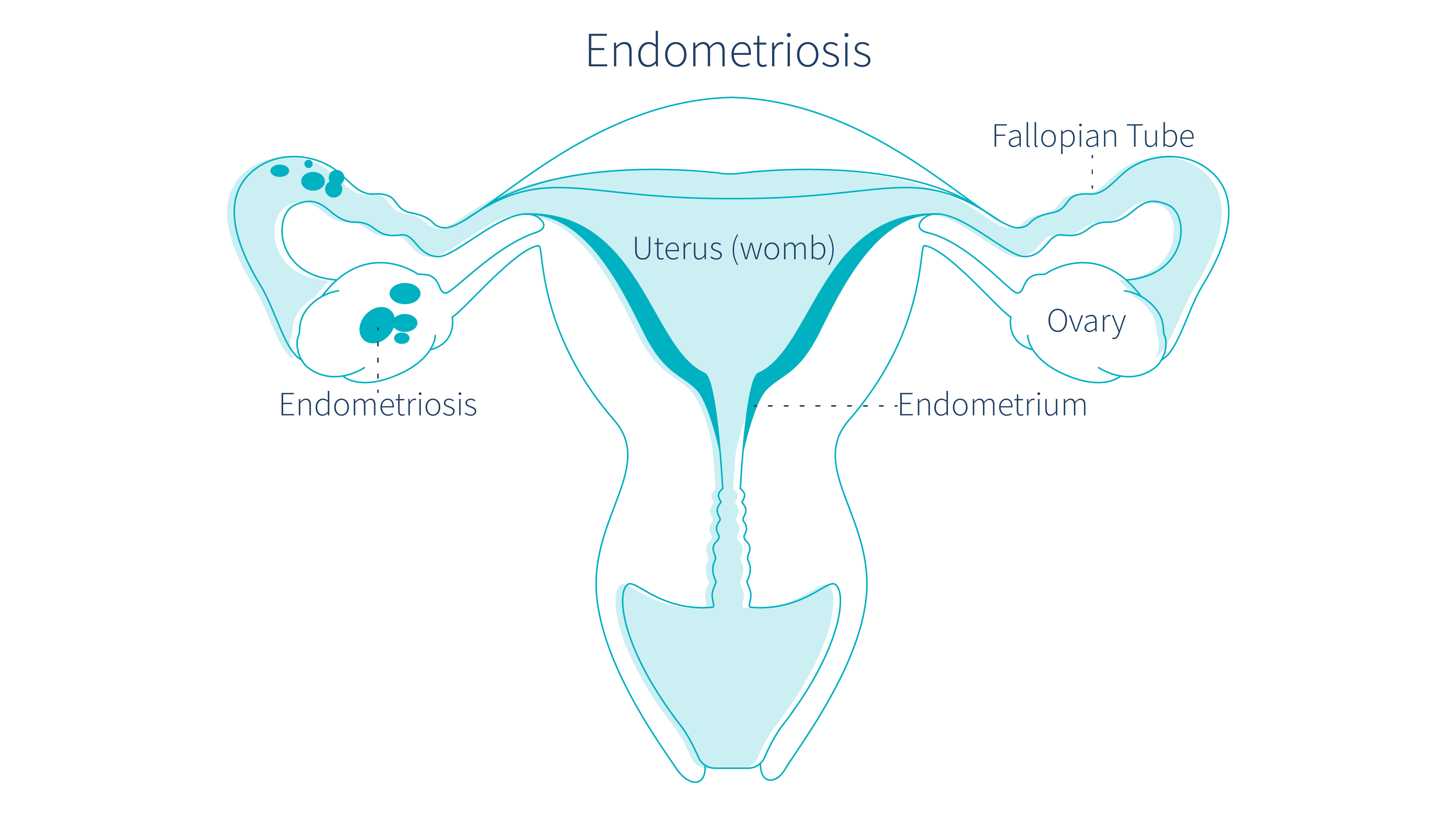 endometriosis-could-be-causing-brown-discharge