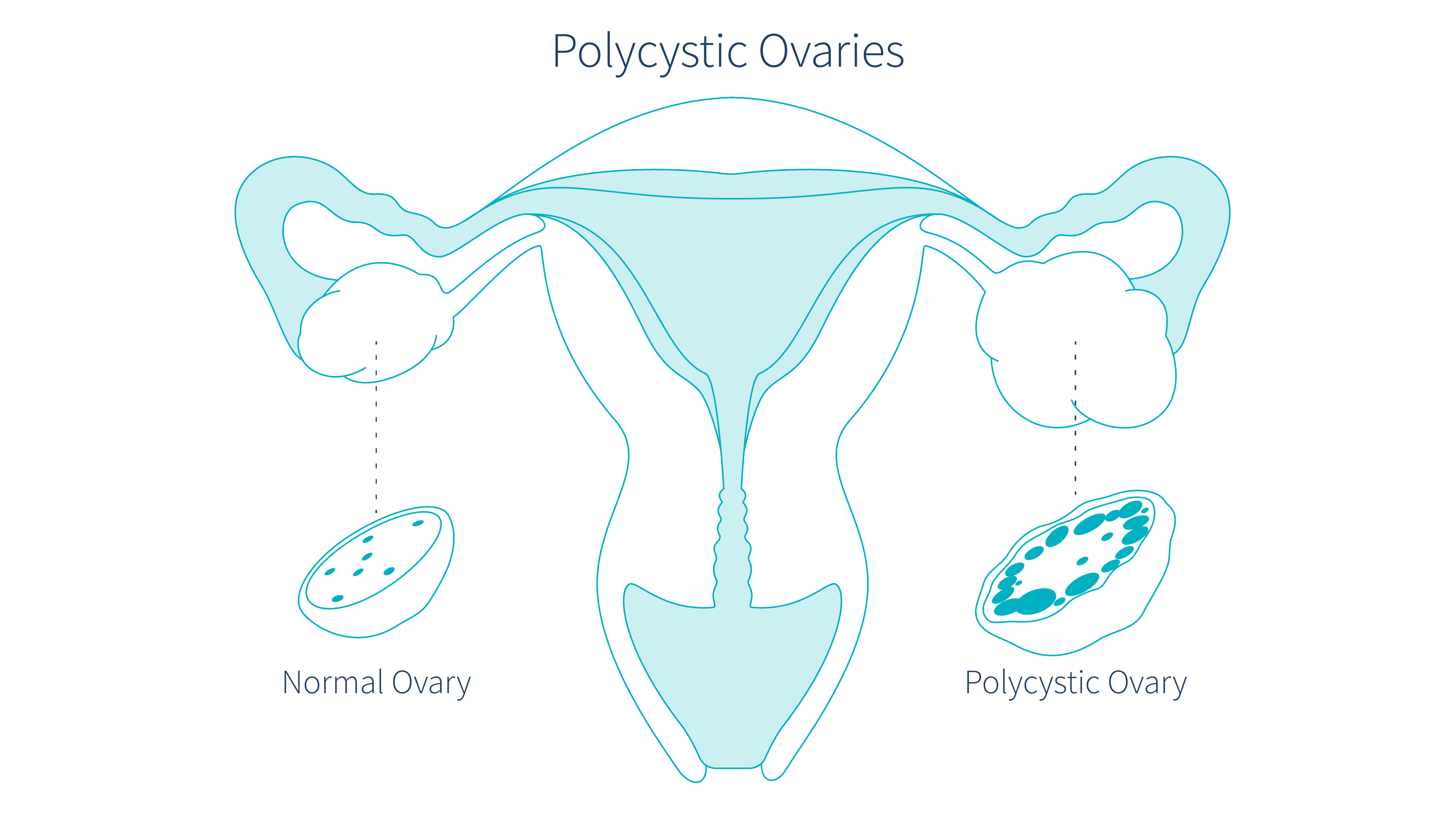 polycystic-ovaries-could-be-causing-brown-discharge-