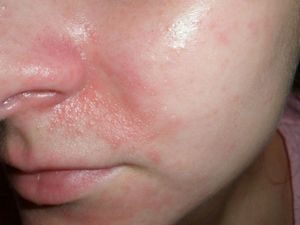 Шелушится кожа на носу вследствие чрезмерной потливости