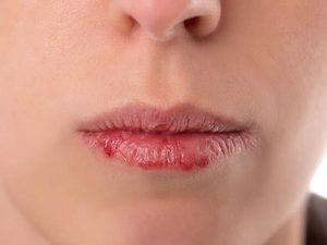 Сухость губ причины какой болезни