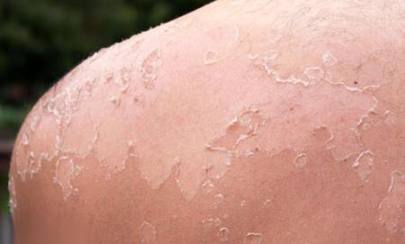 Шелушение кожи после загара