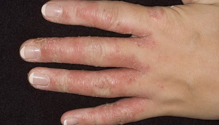 Почему облазит кожа на ладонях? Причины и соответствующие способы лечения