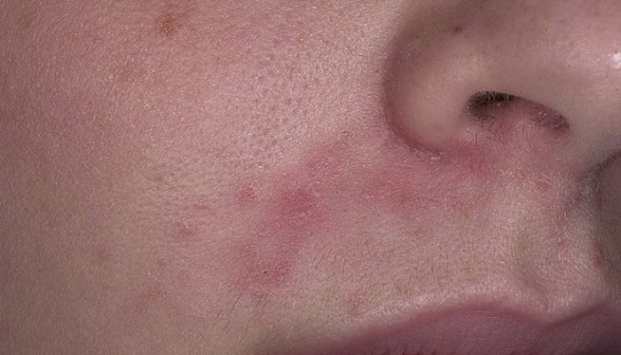 Почему появляются красные точки на лице? Причины проблемы и методы лечения
