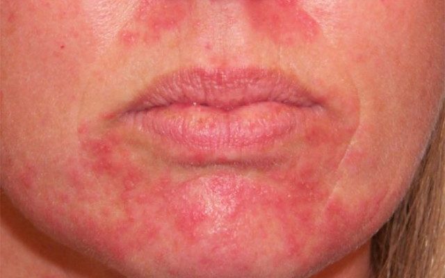 Раздражение кожи после эпиляции на лице: как успокоить легко и быстро?