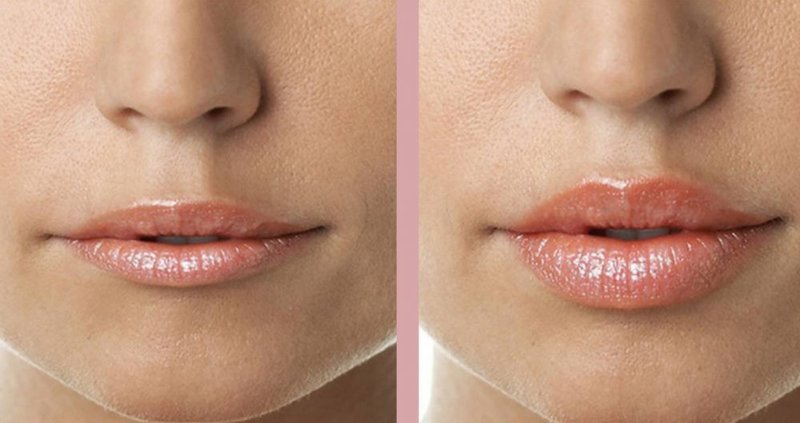 Губы до и после контурной пластики губ гиалуроновой кислотой