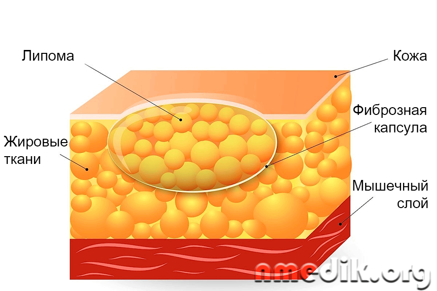 Жировик (липома) - что это такое?