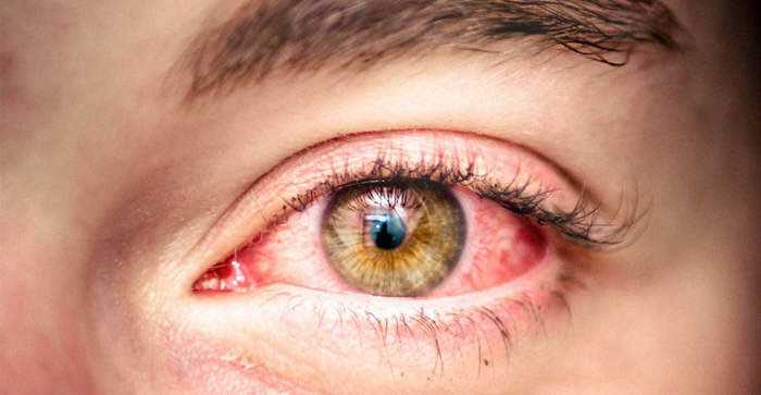 Аллергия глаза: причины и лечение