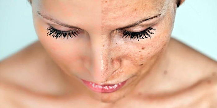 Возрастные пигментные пятна: как эффективно избавиться от дефектов кожи