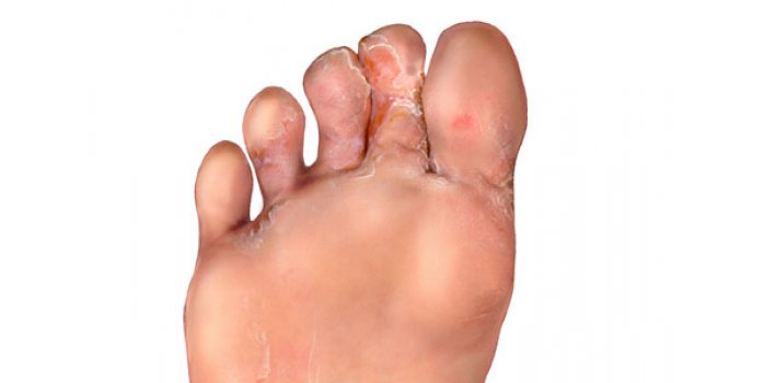 Лечение шелушения и зуда между пальцами ног