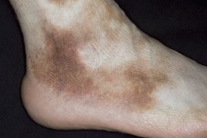 Рожа — воспалительное заболевание кожных покровов