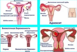Причины болей при месячных