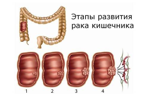 этапы развития рака кишечника