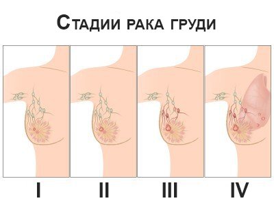 стадии рака груди