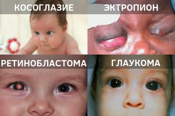 Врожденные заболевания глаз у детей