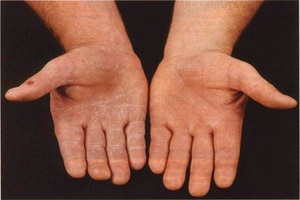 Проблемы с кожей рук из за нехватки витаминов и неправильного ухода