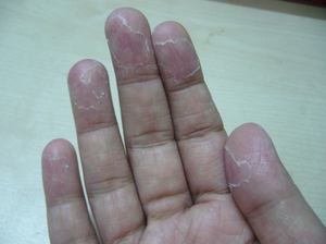 Проблемы с кожей пальцев рук