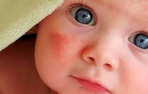 Сыпь на коже лица у ребенка