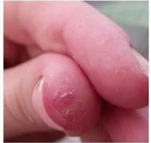 Трескается кожа на пальцах рук у мужчин. Ищем причину появления трещинок