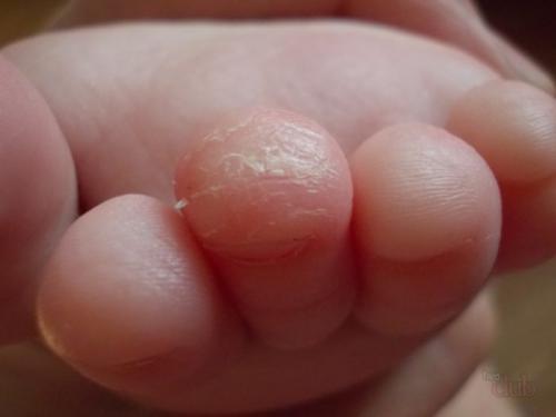 Облазит кожа на пальцах ног у ребенка. Почему шелушатся пальчики у детей?