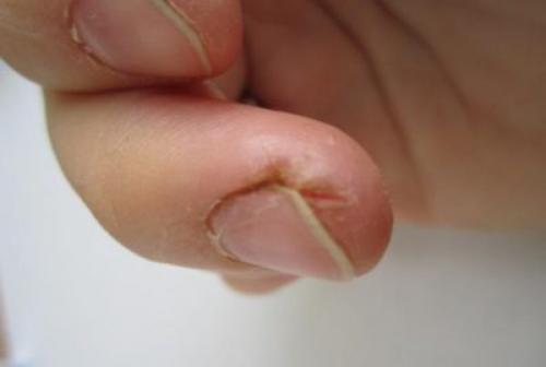 Трескается кожа на пальцах рук возле ногтей. Внутренние факторы