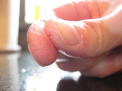 Трескается кожа на пальцах рук возле ногтей. Внутренние факторы