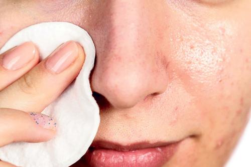 Жирная кожа на носу. Нужно ли избавляться от жирности кожи носа и как это убрать быстро?