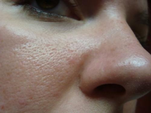 Пористая кожа лица лечение в косметологии. Как избавиться от пористой кожи на лице?